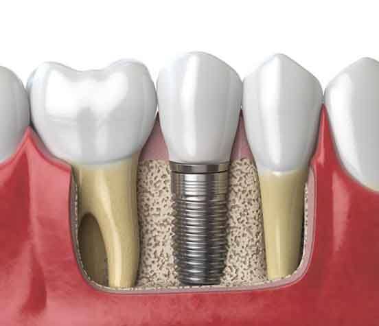 a 3D illustration of a dental implant in the jawbone