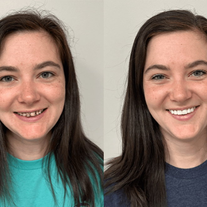 Smiling young woman before and after treatment at Carolina Complete Dental