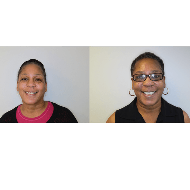 Portrait of woman before and after treatment at Carolina Complete Dental