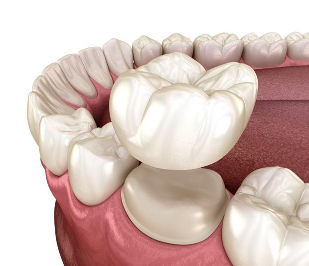 Illustration of crown being placed on prepared tooth