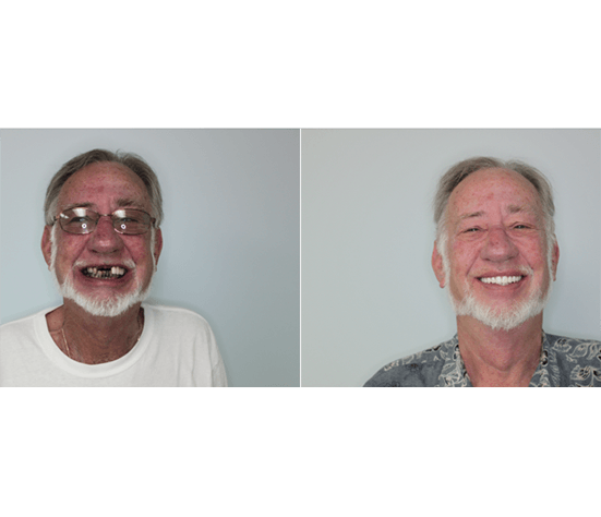 Senior man before and after treatment at Carolina Complete Dental