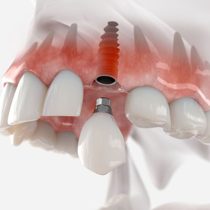 Illustration of a dental implant in upper dental arch