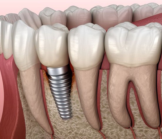 Illustration of infected tissue around a dental implant
