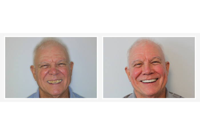 Happy CCD patient before and after his smile makeover
