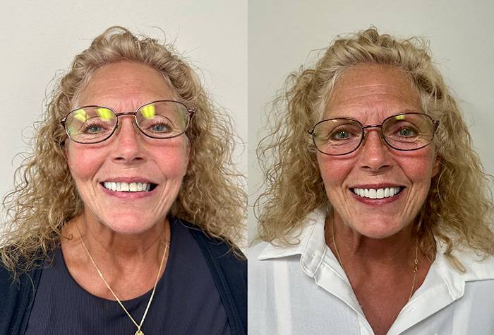 Before and after image of teeth repair