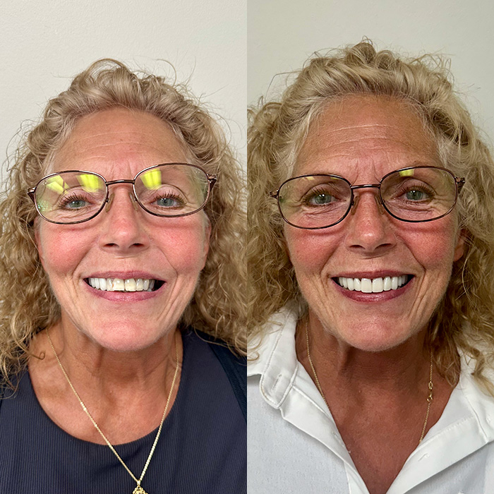 Before and after photo of woman's teeth repair