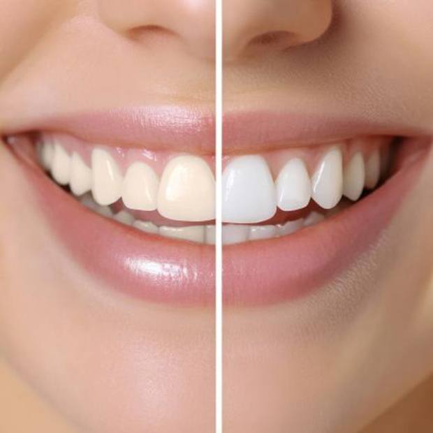 Woman’s smile before and after teeth whitening